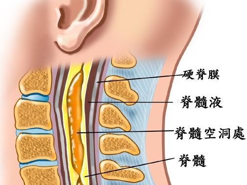 脊髓空洞患者需警惕，切勿耽误病情