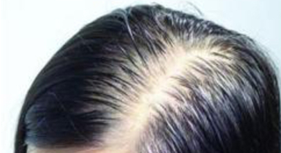 发型固定不变的危害 脱发越来越严重